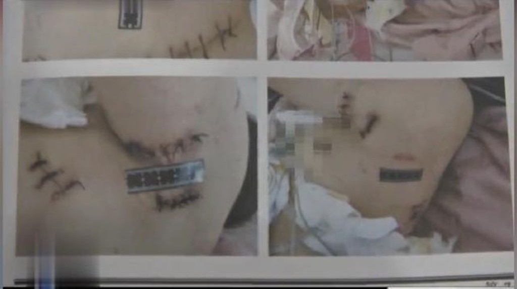 女子身上留下17條大小不一的刀疤。 網圖