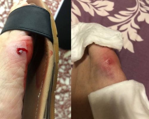 有乘客在港鐵車廂內，被一名穿斗零踭高踭鞋的內地女子踩中，腳趾流血。fb群組「將軍澳」