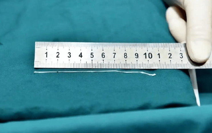37歲男腦內藏10cm活蟲。羊城晚報 37歲男腦內藏10cm活蟲。羊城晚報