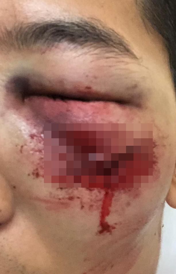 男子被橡膠彈擦面而過，血痕至少3厘米長。網圖