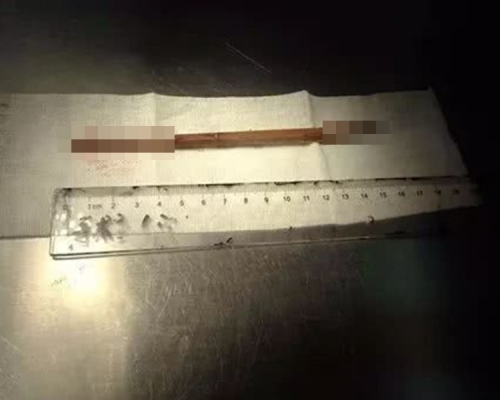 内地一名岁半女婴边食饭边玩，不慎跌倒筷子刺穿脑部。网上图片