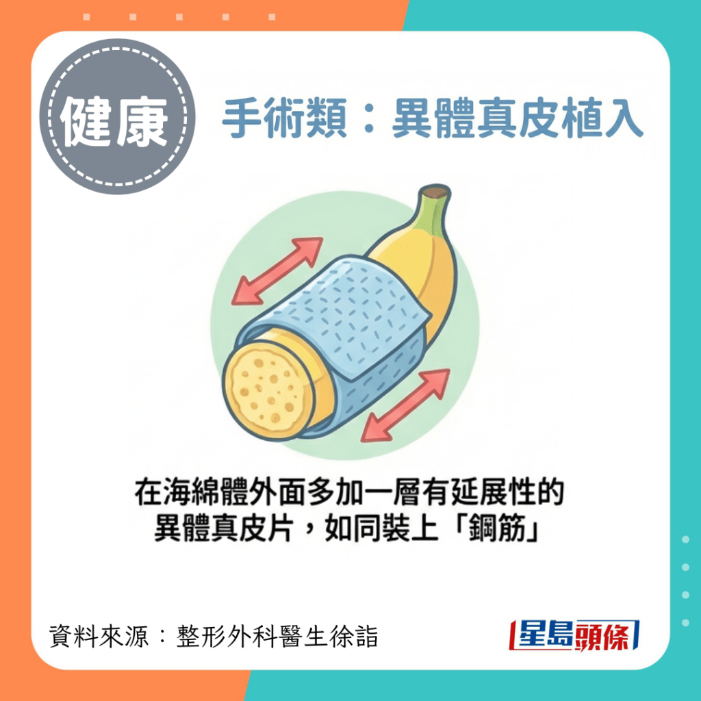 把皮肤层剥下来，在海绵体外面多加一层有延展性的异体真皮片，如同装上“钢筋”