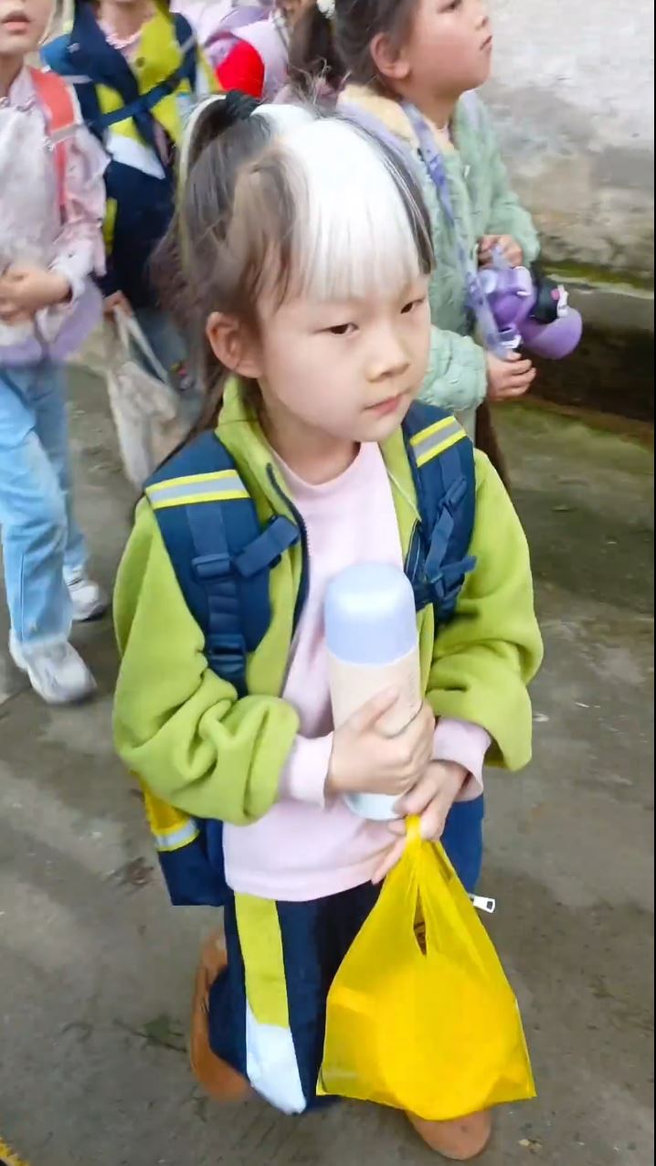 文汐患罕见的“斑驳病”，头上天生显眼的白色浏海。