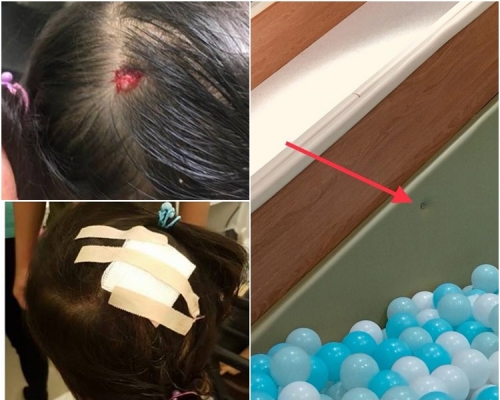 圖左,女童頭部受傷,需縫針治理。圖右為涉事的螺絲。網圖