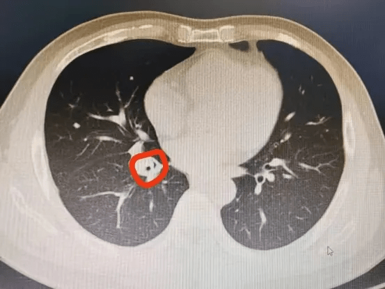 掃瞄提示氣管狹窄。