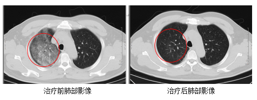 顧先生的雙肺，治療前後影像比較。