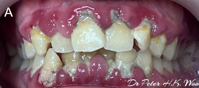 事主治疗牙周病前的牙齿情况。（受访者提供）