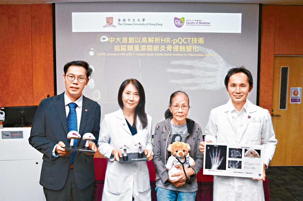 中大首創以高清電腦掃描技術HR-pQCT追蹤類風濕關節炎骨侵蝕變化，幫助患者「早診早治」。