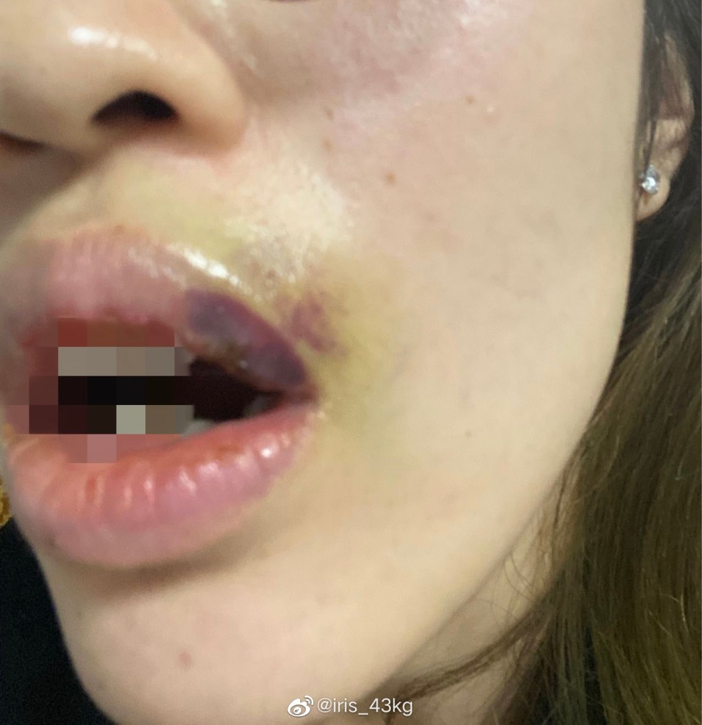 「iris_43kg」同時貼出受傷照片，她在文中指兩度遭對方掌摑，更遭受對方言語暴力。