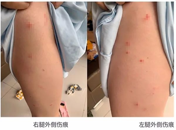 受害女事主腿部受傷照片。(圖片來源於舉報信截圖)