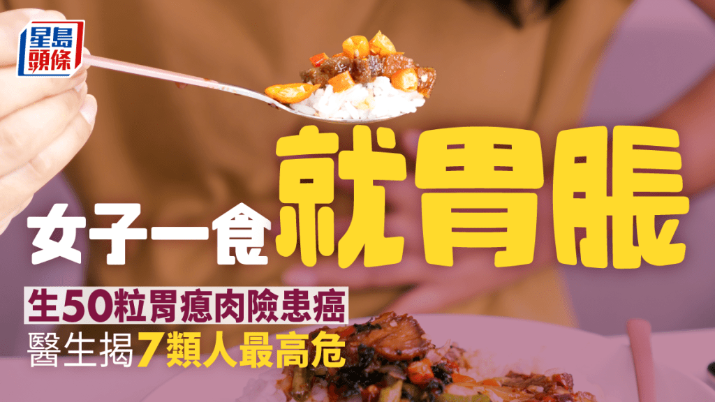女子長期胃脹揭有50粒瘜肉恐變癌症