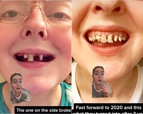 美國一名20歲女子將自己的蛀牙經歷拍成影片，呼籲大家關注牙齒健康。網圖