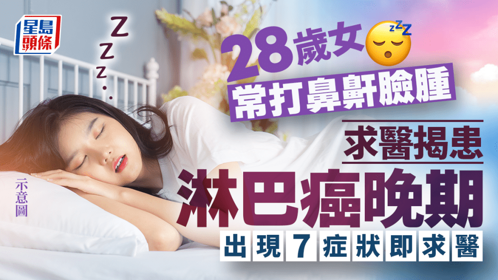 28歲女常打鼻鼾臉腫 求醫揭患淋巴癌晚期 出現7症狀即求醫