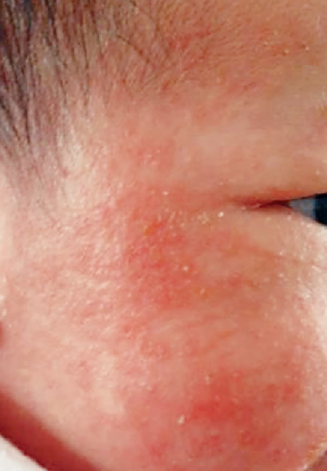 中医称BB湿疹为「婴儿湿疮」,又称「奶癣」。 中医称BB湿疹为「婴儿湿疮」,又称「奶癣」。