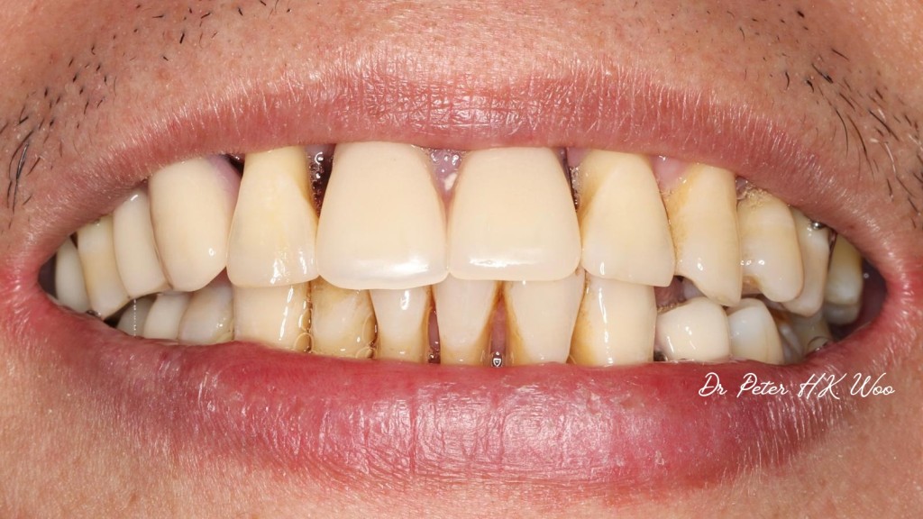 因患嚴重牙周病而失去牙骨、牙肉及牙齒的患者，最終選擇做假牙取代缺失的牙齒。（受訪者提供）
