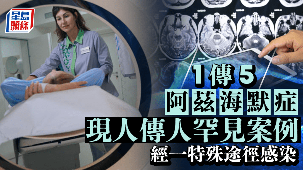 阿茲海默症現「人傳人」罕見案例  最年輕患者38歲  經一特殊途徑感染
