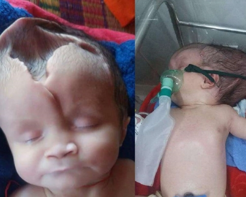 柬埔寨一名只有兩個月大的女嬰不幸患有無腦畸形症，天生缺少部分頭骨和大腦。