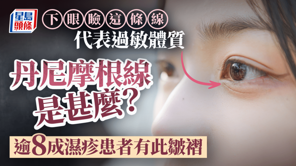 下眼睑这条线代表过敏体质？了解丹尼摩根线 逾8成湿疹患者有此皱褶