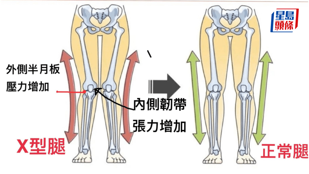 如果膝蓋中心坐落在內側腳踝甚至腳踝的內側,便可能有X形腿;而趾公姆外翻等,通常都會與X形膝同時出現。圖片由筆者提供