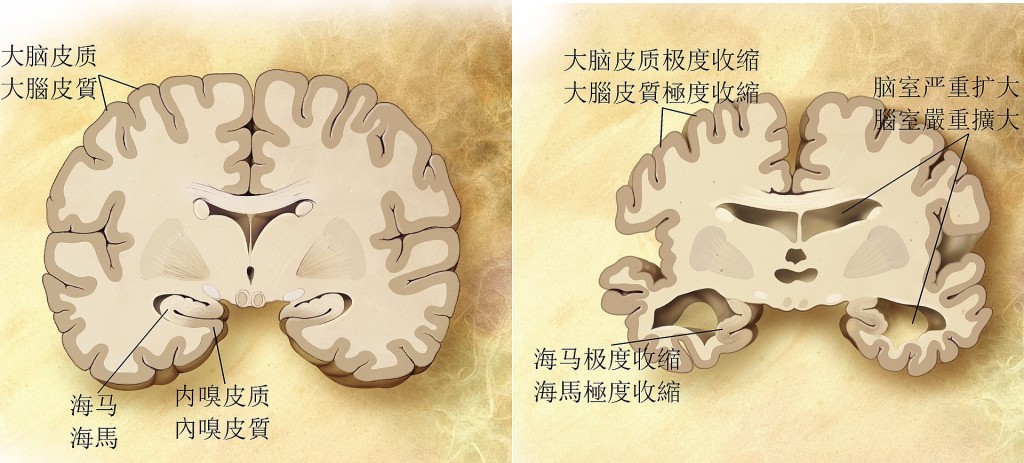 患老年痴呆症大腦（右）和正常的大腦有明顯分別。