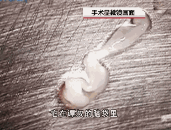 2019年,內地浙江一名46歲男子在家中打邊爐時,吃進未煮熟的豬肉及羊肉,體內長有700多條寄生蟲,甚至鑽進他的大腦。 2019年,內地浙江一名46歲男子在家中打邊爐時,吃進未煮熟的豬肉及羊肉,體內長有700多條寄生蟲,甚至鑽進他的大腦。