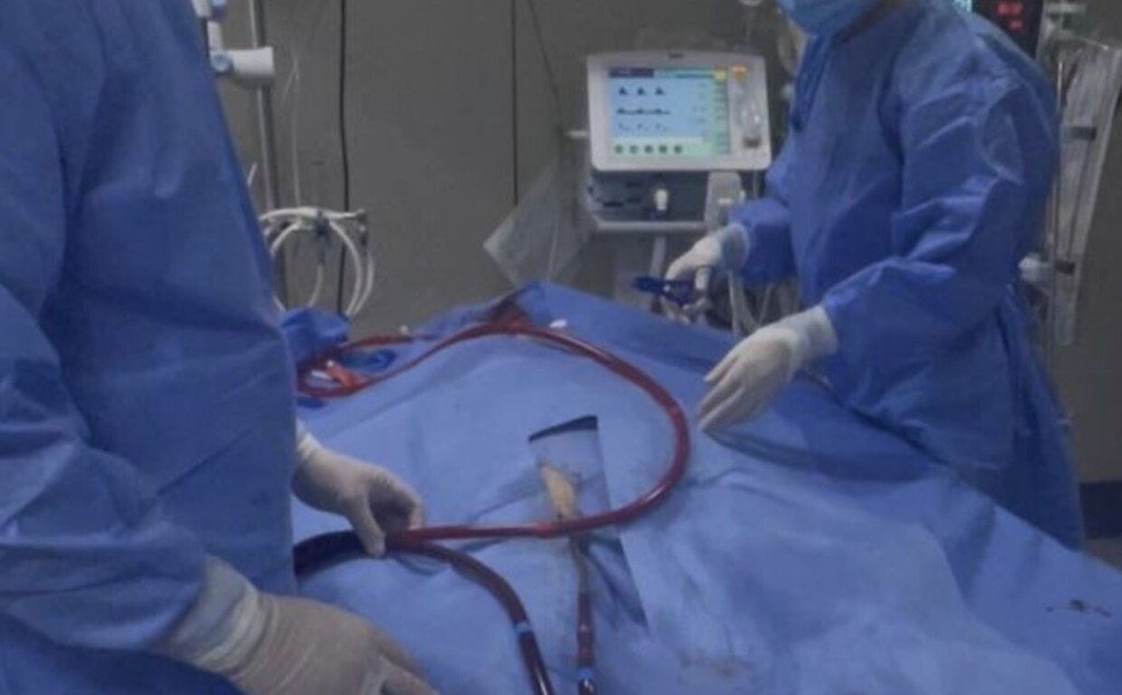 醫療團隊為劉先生老伴安裝ECMO。大象新聞