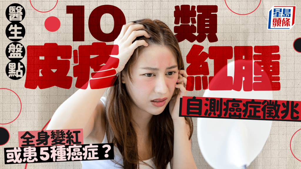 醫生盤點10類皮疹紅腫 自測癌症徵兆 全身變紅或患5種癌?