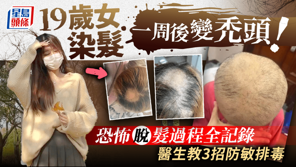 染髮脫髮｜19歲女染髮一周後禿頭 毛囊壞死過程全記錄 醫生教3招防敏排毒