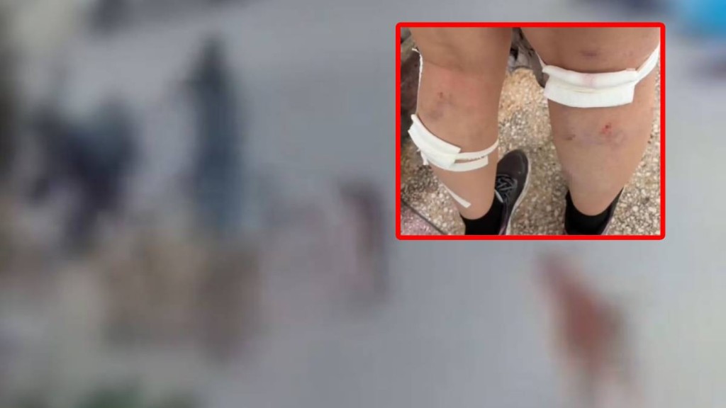 河南平頂山學院有女大生，在校園遭群狗撕咬致有逾20傷口。極目新聞