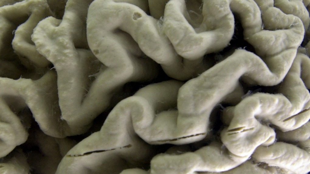 紐約州布法羅大學神經解剖學博物館展示阿茲海默症患者大腦的一部分。AP