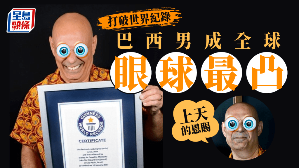 巴西男子打破眼球凸出最遠世界紀錄。