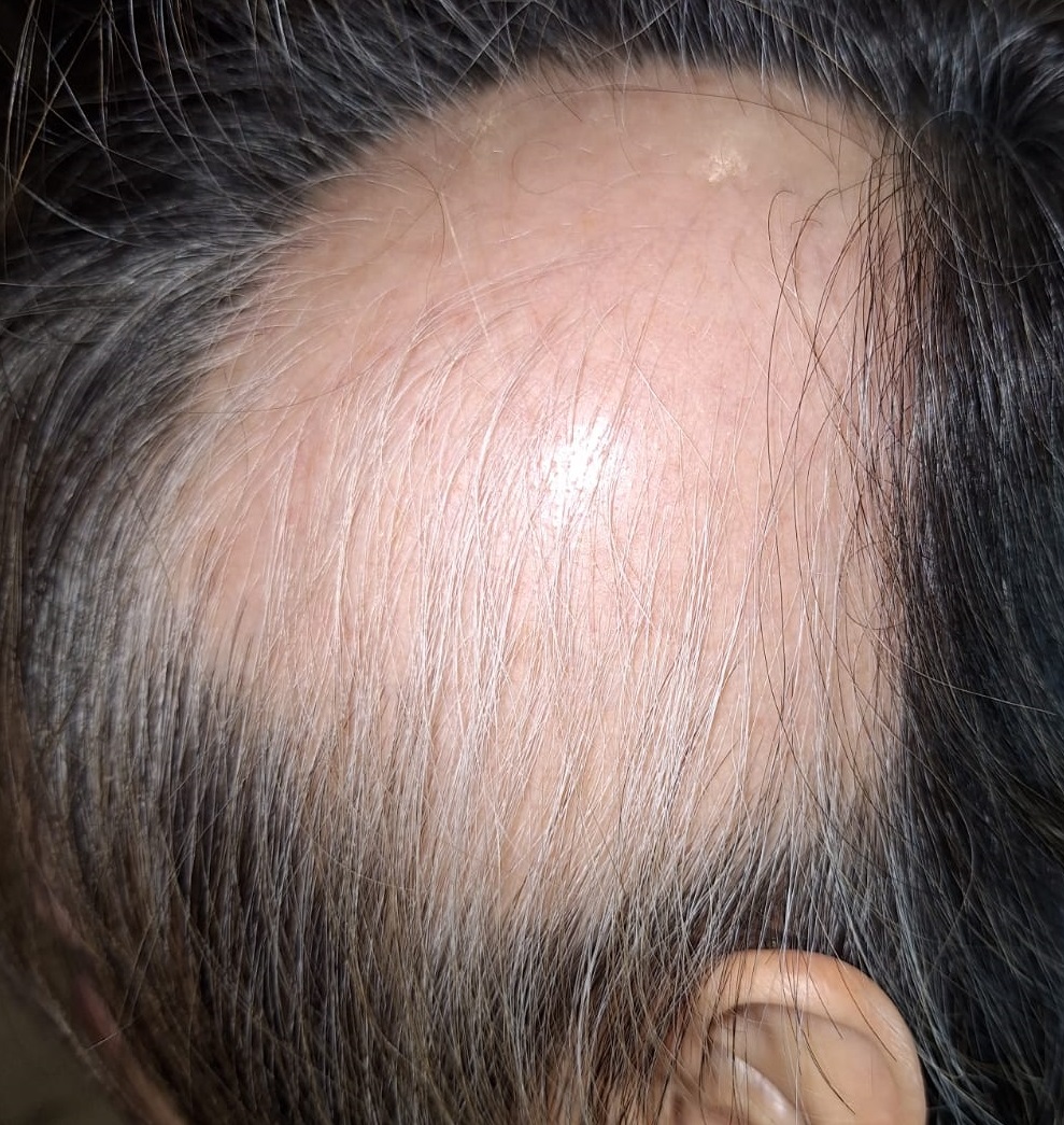 壓力及曾患大病是導致出現廣泛性脫髮的主要原因。(圖片來源:醫生提供) 壓力及曾患大病是導致出現廣泛性脫髮的主要原因。(圖片來源:醫生提供)