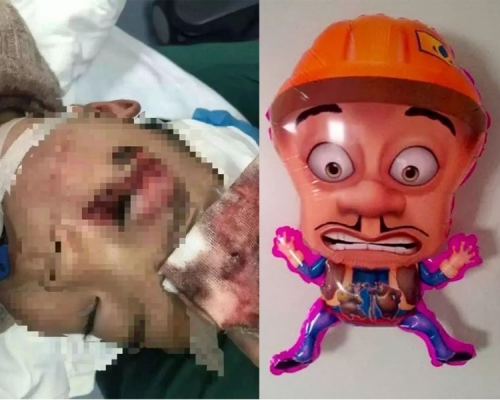 一名3歲男童因氫氣球爆破，導致男童的右眼瞬間被炸，臉部重創需要縫逾100針。（網圖）