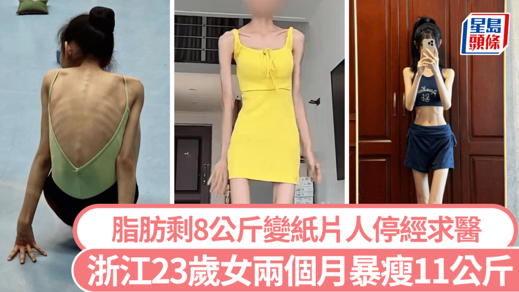 浙江23歲女兩個月暴瘦11公斤 脂肪剩8公斤變紙片人停經求醫。小紅書示意圖