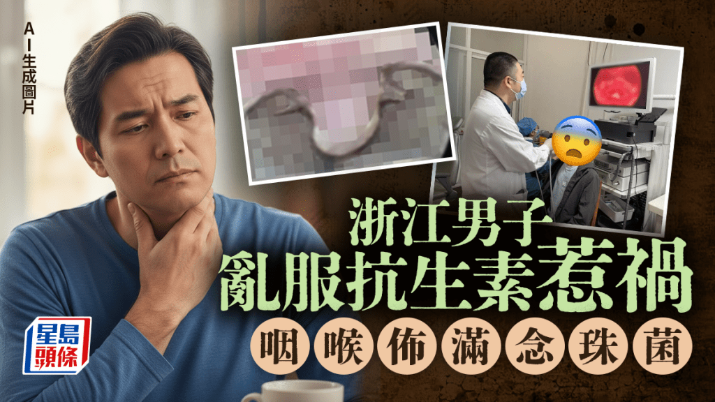 亂食抗生素︱浙江男真菌性咽喉炎   咽喉佈滿「雪花」念珠菌