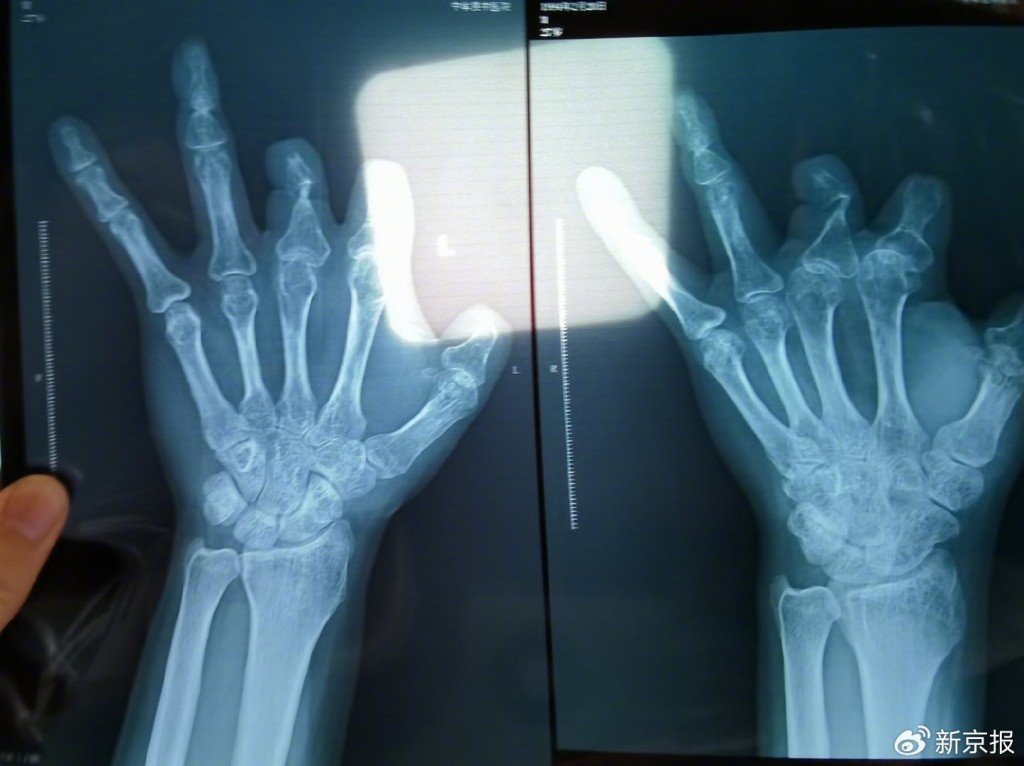 王海森發現體內並無植入血管吻合裝置。新京報