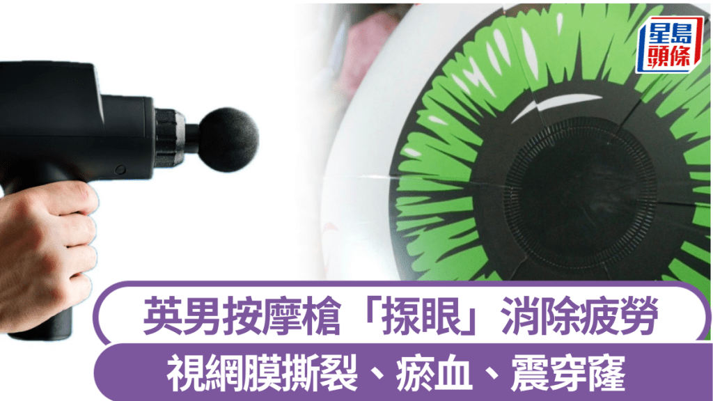 按摩枪｜英男眼睛疲劳直接「揼眼球」　视网膜撕裂震穿窿