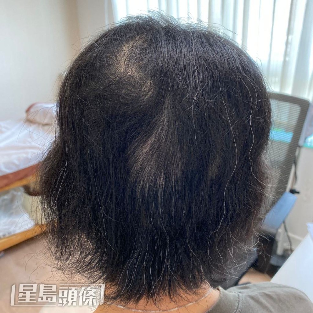 經治療1個月後，該患者再長出頭髮，髮量明顯增加，回復至大約60至70%。（相片由註冊中醫師李灼梅提供）