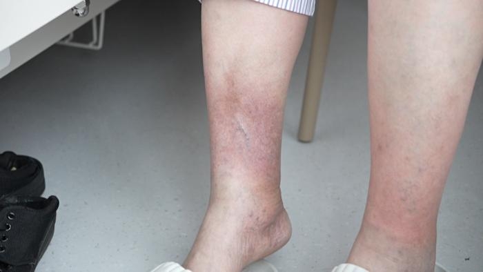感染基孔肯雅熱後出現的關節痛主要累及踝、指、腕等遠端小關節,也可累及膝、肩等大關節。 感染基孔肯雅熱後出現的關節痛主要累及踝、指、腕等遠端小關節,也可累及膝、肩等大關節。