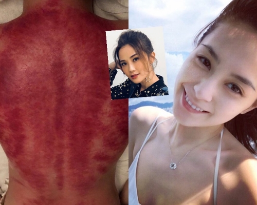 阿娇的背伤令人担心。