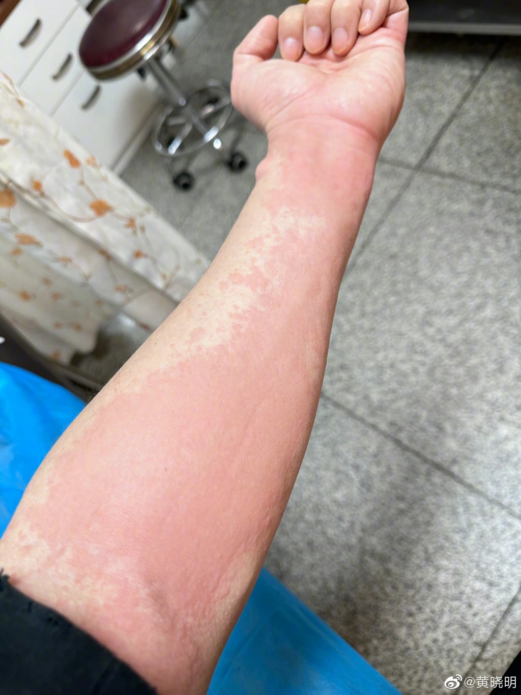 黃曉明最近返青島歎不少家鄉菜後，手臂卻出現急性蕁麻疹。