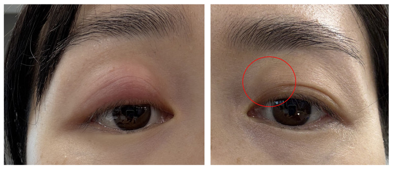 圖中女士右眼先出現麥粒腫,痊癒不久後,左眼又出霰粒腫。 圖中女士右眼先出現麥粒腫,痊癒不久後,左眼又出霰粒腫。