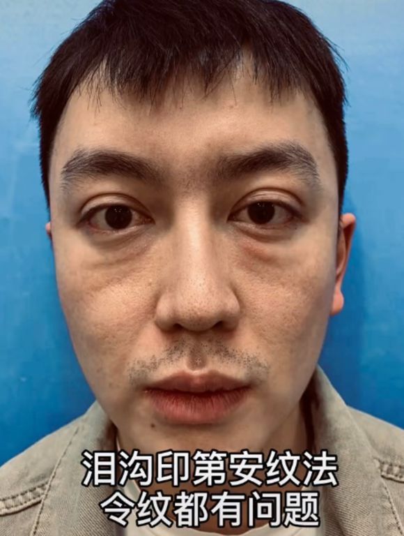 金大威到美容診所接受脂肪填充手術,沒想到竟整容失敗。網圖