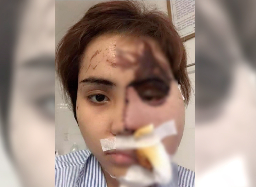 越南男警懷疑妻子出軌潑強酸毀容。網上圖片