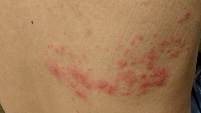 本港每3人即有一人曾经患有俗称「生蛇」的带状疱疹，而且有年轻化的趋势。资料图片