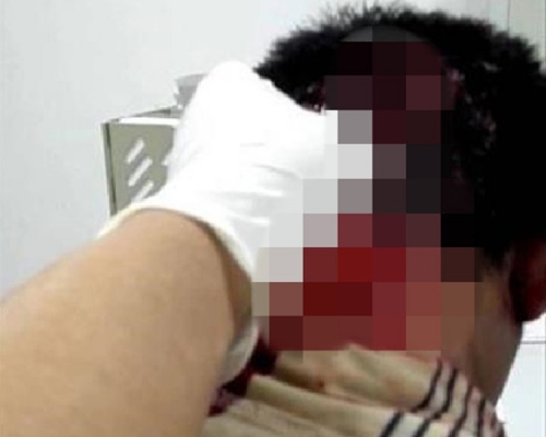 醫生指李男頸部燒傷，後腦頭皮炸裂。網圖