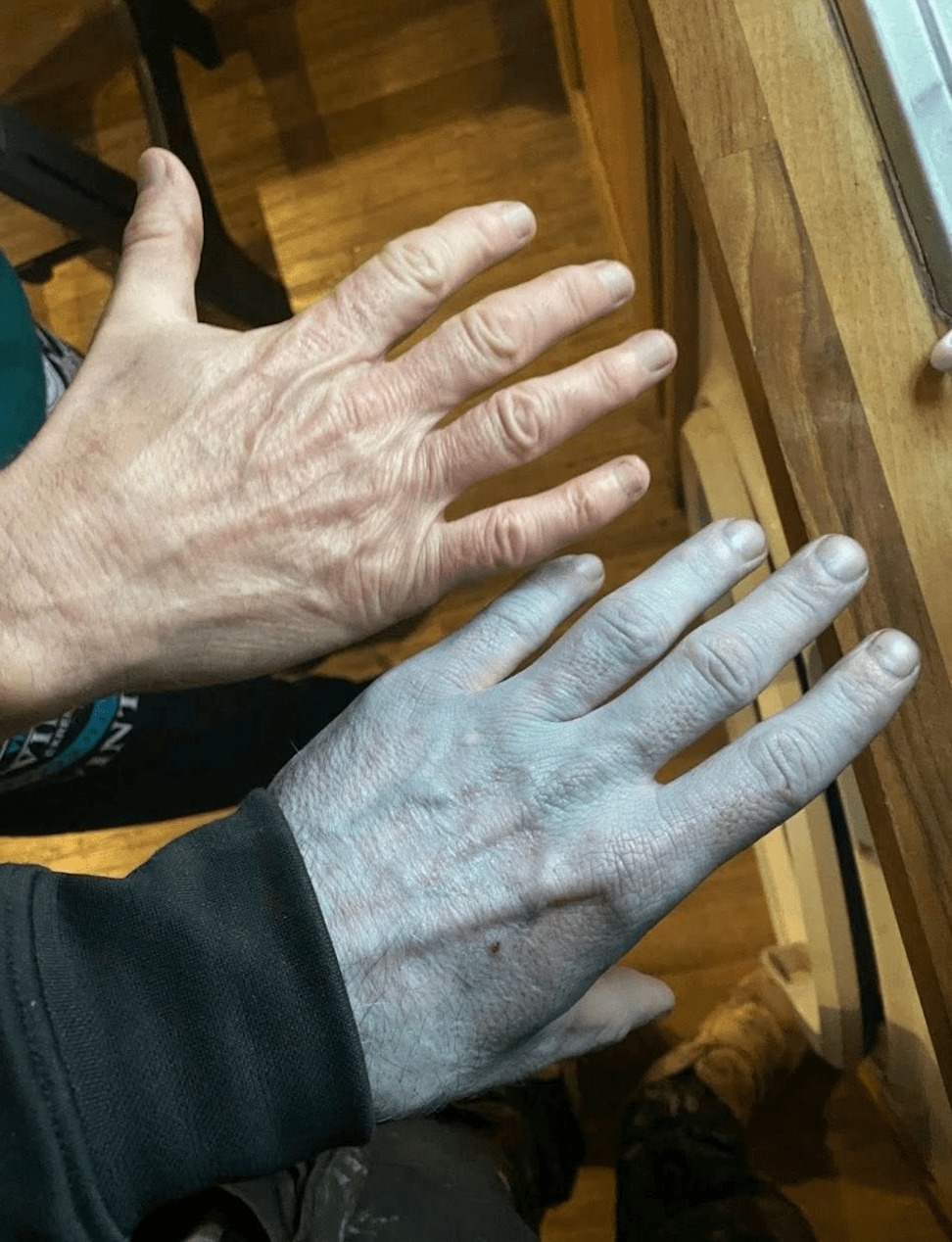 林某日清晨醒來，驚覺自己全身皮膚呈現詭異的藍色，外貌酷似電影《阿凡達》中的納美人。。fb@TommyLynch（下同）