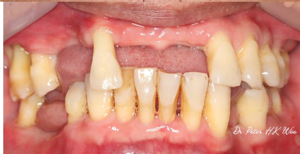 胡瀚钧医生分享另一宗牙周病病例，相片中的患者患有严重牙周病，经治疗后病情虽已受控 （可见牙肉呈粉红色，没有肿胀），但失去了的牙骨、牙肉及牙齿已难以逆转。（受访者提供）