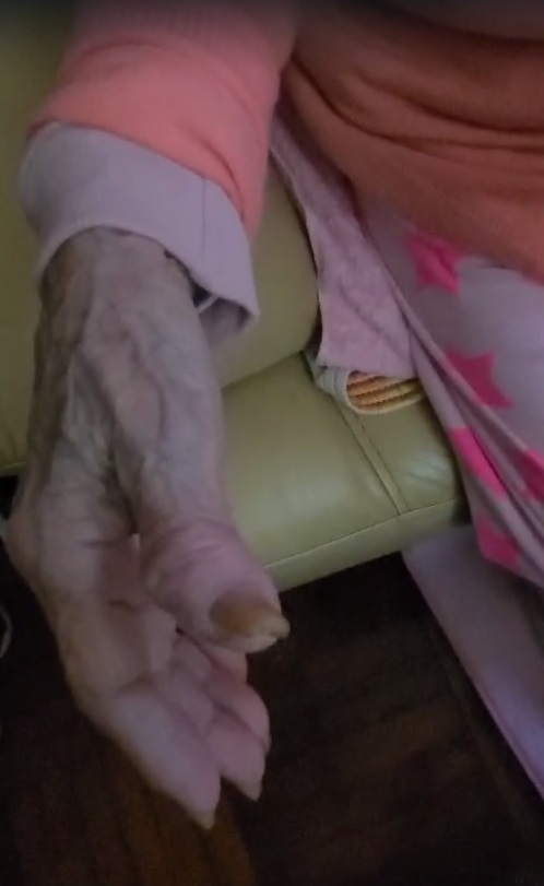 由于手脚甲十年没有修剪，指甲长逾2厘米发黄病变，不断增生发炎。(受访者提供图片)