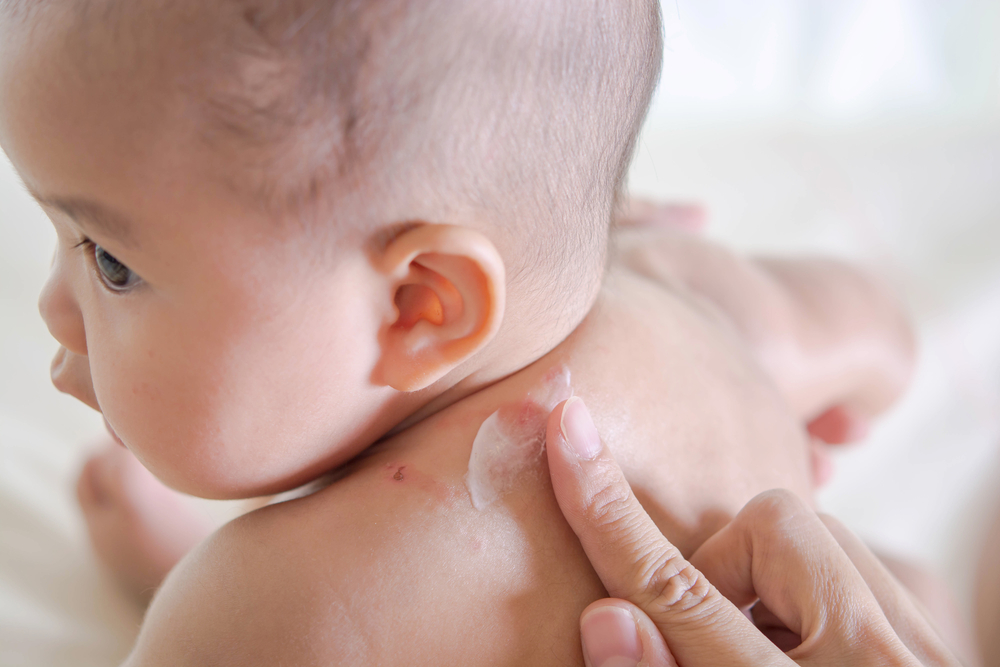  ■ 要减低婴儿患湿疹机会，最重要是先从饮食与环境方面著手。